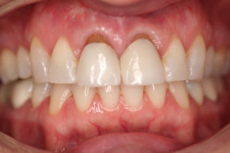 What Are Gums (Gingivae)?