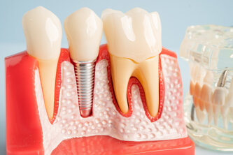 Read more about the article Placement of Dental Implants