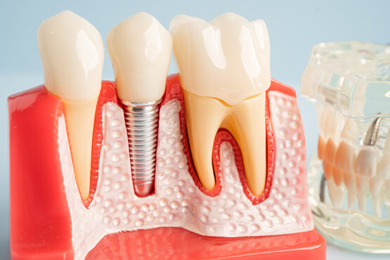 dental implants with Bucks County Dental Design