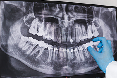 Read more about the article Are Dental X-Rays Really Necessary? Understanding the Benefits and Safety