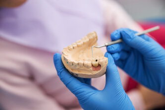 Read more about the article Dental Fillings vs Crowns – when do you need one or 2?