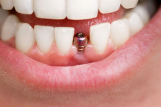 dental implants richboro dentist