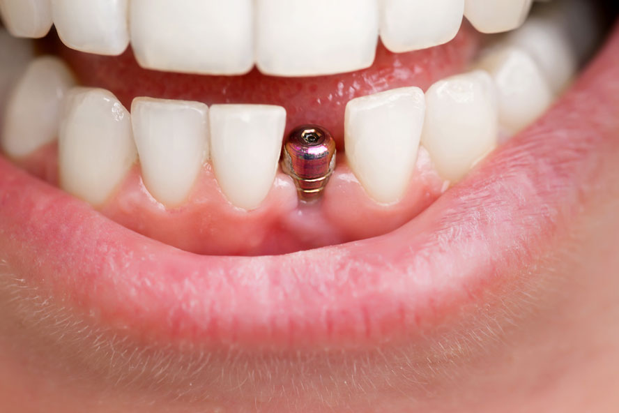 Read more about the article The Placement of Dental Implants: What You Need to Know About This Modern Tooth Replacement Option