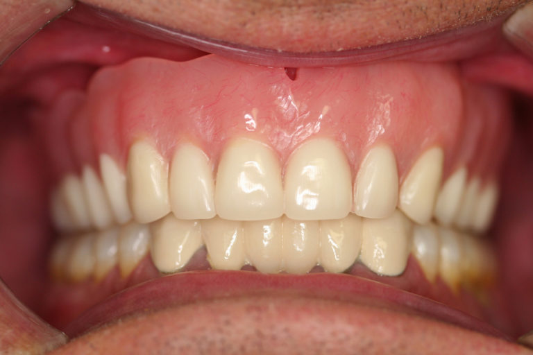 Cosmetic Full and Partial Dentures Bucks County Dental