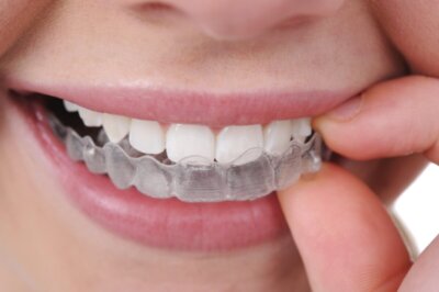 Read more about the article Straightening Teeth with Invisalign